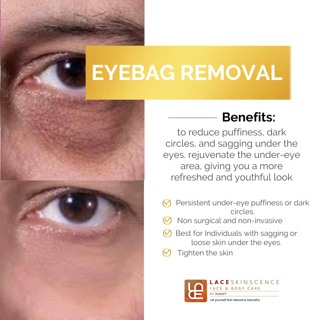Eye Bag Removal 